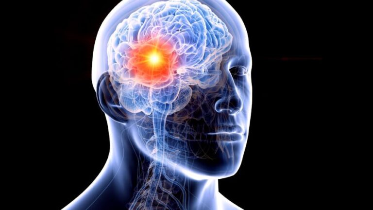 Glioma: Avanços no Combate ao Câncer Cerebral e da Medula. O que é o Glioma e por que é tão Desafiador? Acompanhe em nosso site